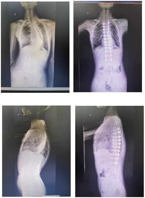 先天性脊柱后凸图片